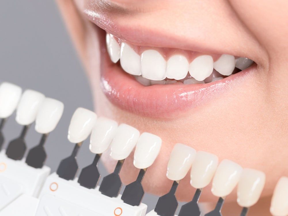 teeth whitening in country hills