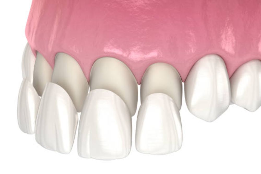 Porcelain veneers in Country Hills