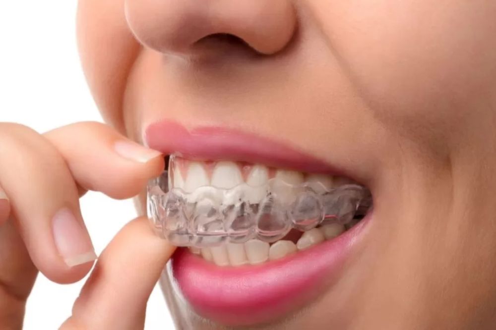 Invisalign treatment