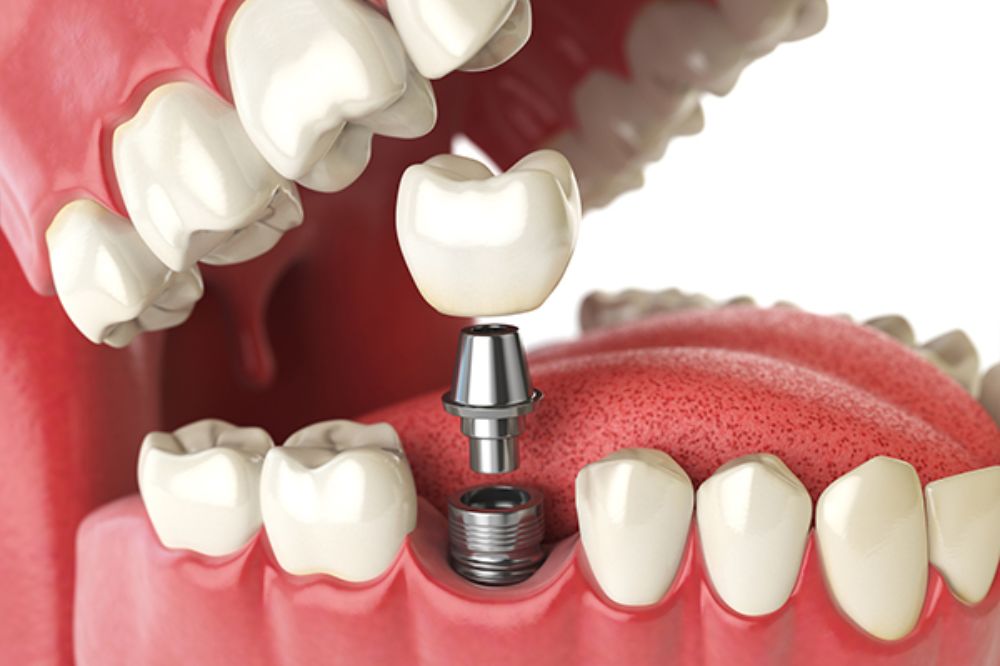 dental implants near you