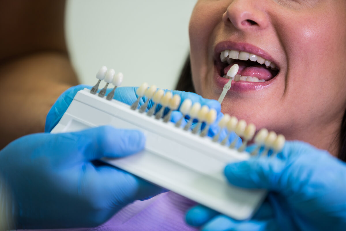 can you go back to regular teeth after veneers