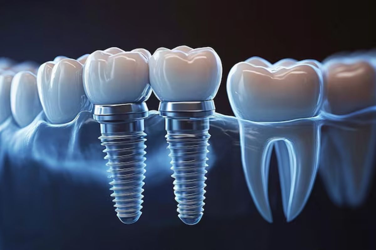 Dental Implants Supporting Permanent Tooth Replacement For A Natural And Functional Smile